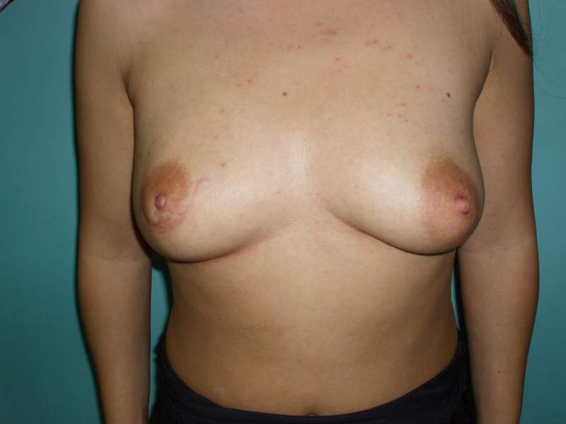1. Reconstruction with latissimus dorsi flap